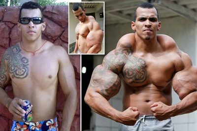 se brésilien s’injecte des produits pour ressembler à Hulk, ses muscles se transforment en pierre